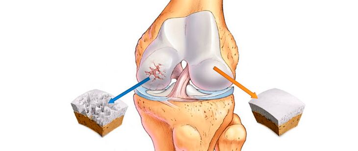 Deformierende Arthrose des Kniegelenks (links) und ein gesundes Gelenk (rechts)
